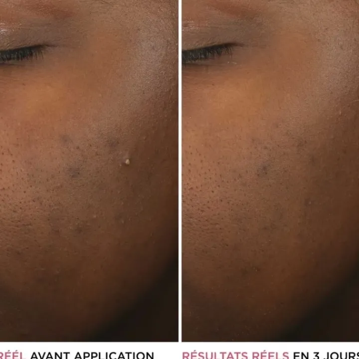 It Cosmetics Bye Bye Breakout Sérum anti-acné à l'acide salicylique