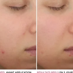 It Cosmetics Bye Bye Breakout Sérum anti-acné à l'acide salicylique